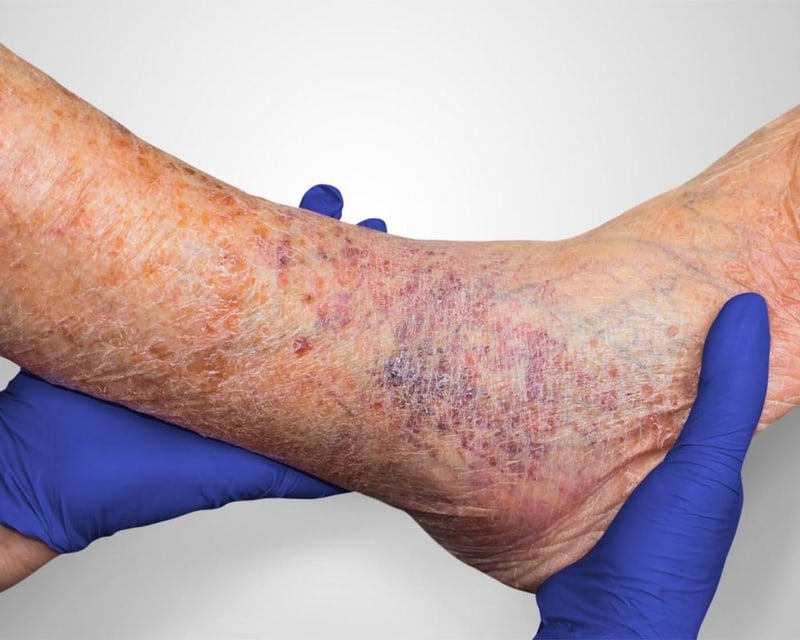 Leg Ulcers How to Relieve the Pain at Home Blog South Valley Vascular